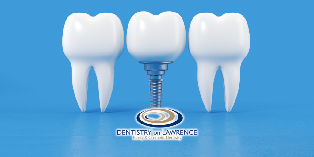 dental implants - Dentistry on Lawrence blog feb 25