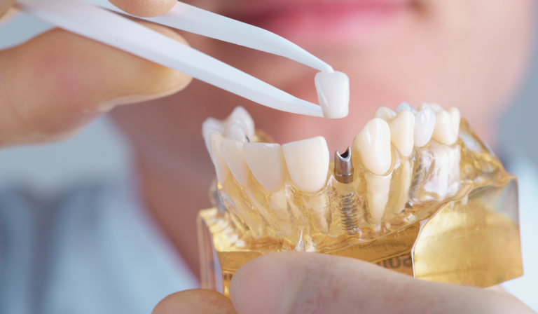 Dental implants comparison chart showing different tooth replacement options at Dentistry on Lawrence